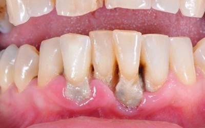 Viêm tủy răng có mủ là bệnh gì? Giải pháp khắc phục nhanh chóng từ thiên nhiên
